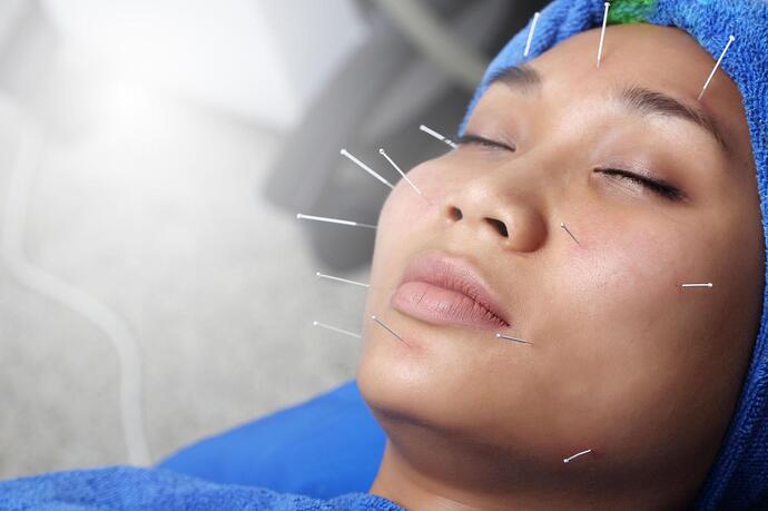 Facial acupuncture treatment using fine needles to boost collagen, improve circulation, and support natural skin rejuvenation.
